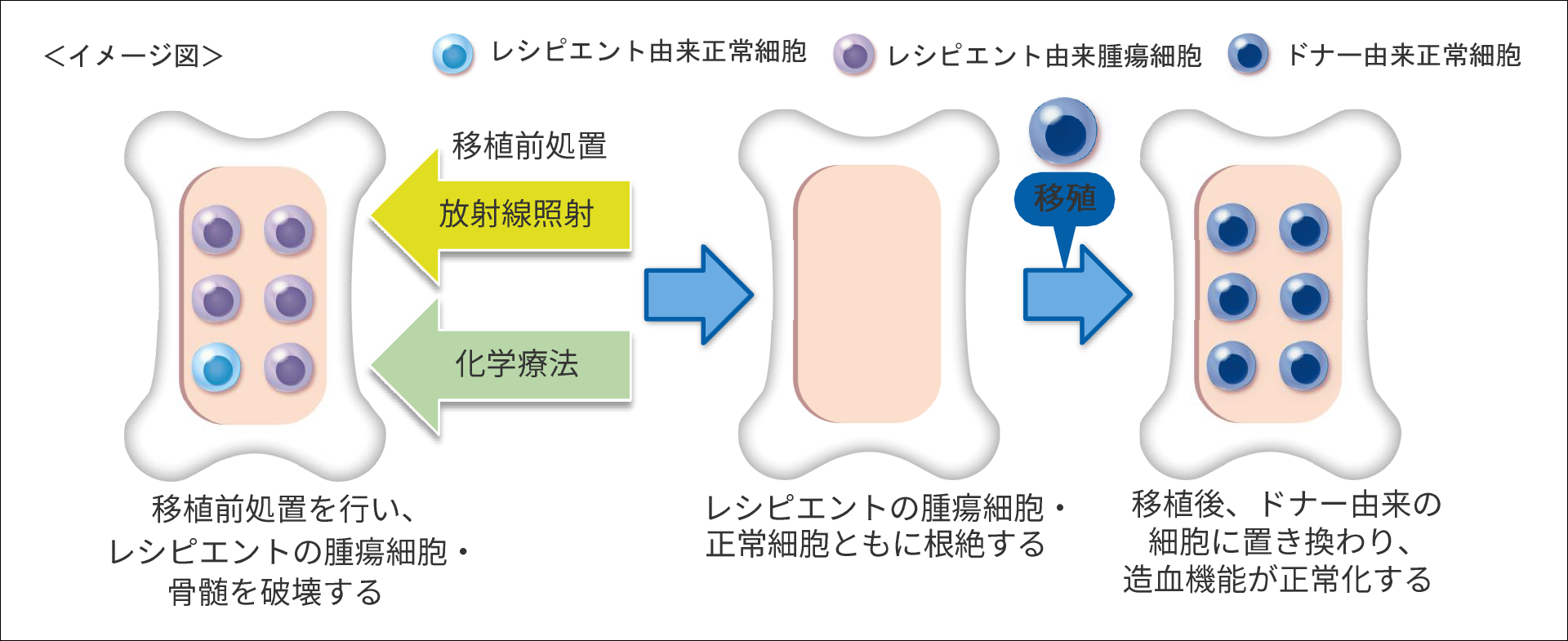 造血幹細胞移植